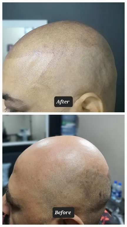 Syinger Tattoos scalp micropigmentation work
