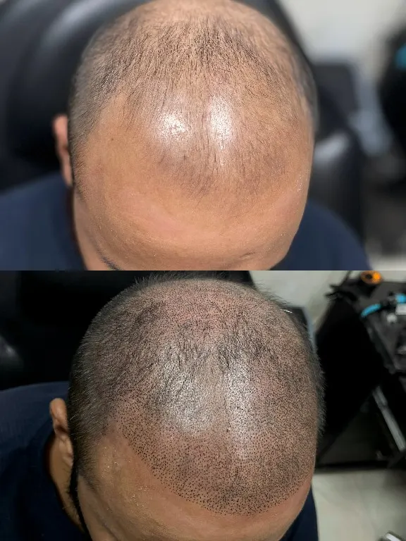 Syinger Tattoos scalp micropigmentation work