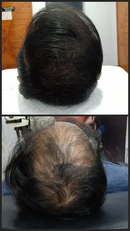 Syinger Tattoos scalp micropigmentation work