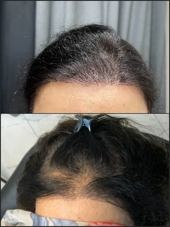 Syinger Tattoos scalp micropigmentation work
