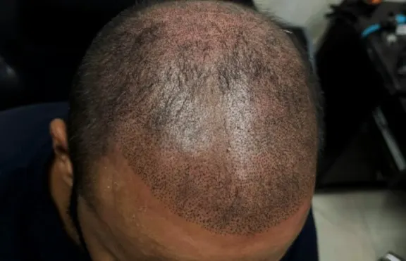 Scalp micropigmentation service at Syinger Tattoos