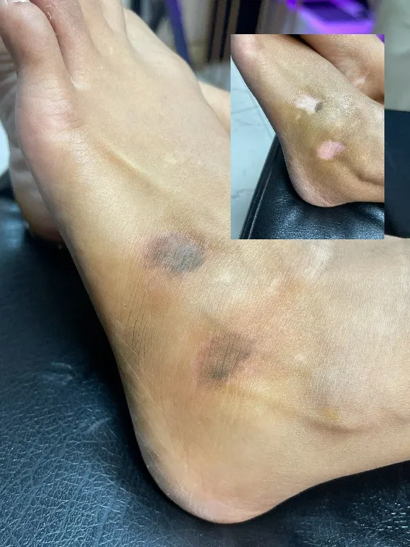 Syinger Tattoos vitiligo treatment work
