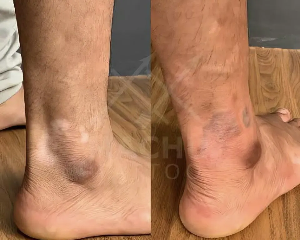 Syinger Tattoos vitiligo treatment work
