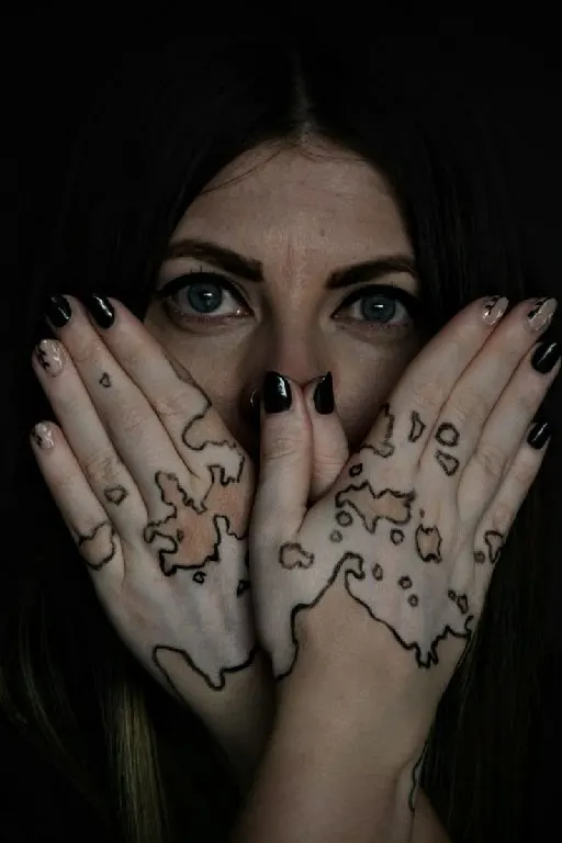 Syinger Tattoos vitiligo treatment work