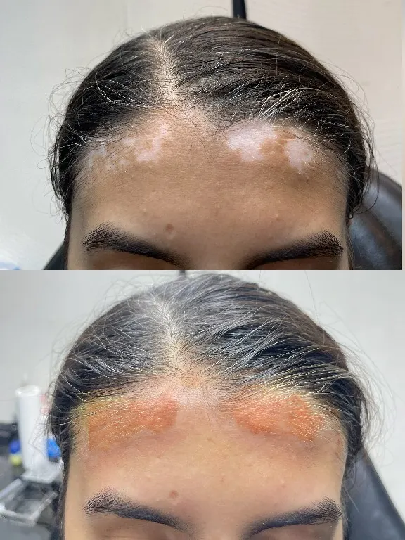 Syinger Tattoos vitiligo treatment work