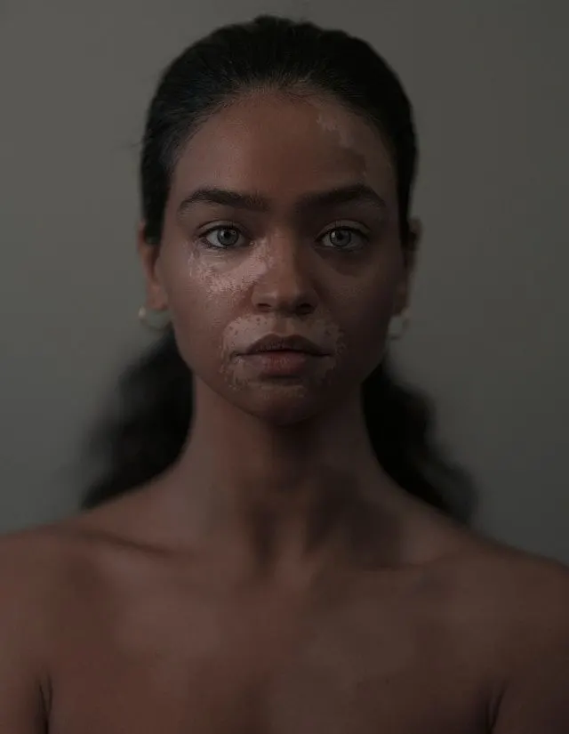Vitiligo treatment service at Syinger Tattoos